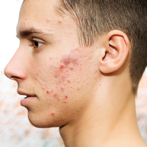 acne